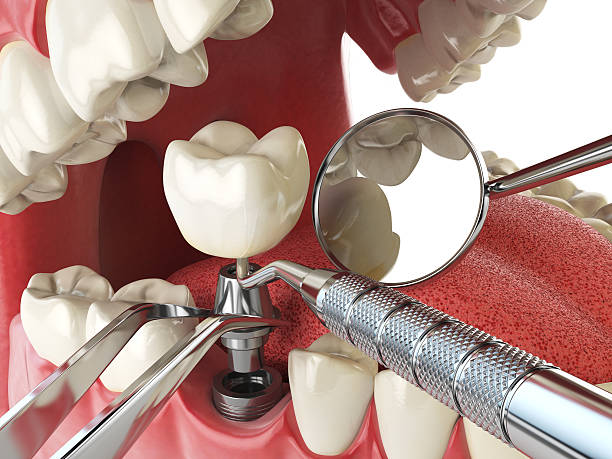 Best Emergency Treatment for Dental Infections or Abscesses in Laurel, DE
